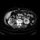Postpyelonephritic changes, nephrolithiasis, kidney stones: CT - Computed tomography